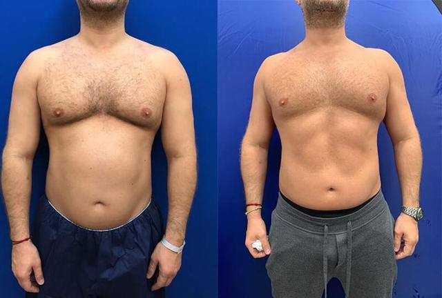Thigh Lift result at Neinstein Plastic Surgery in New York, NY