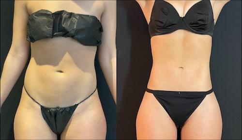 Neinstein Plastic Surgery liposuction result — New York, NY