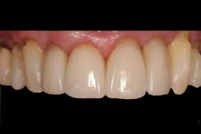 Dentistry of Newport Beach smile makeover after — Newport Beach, CA