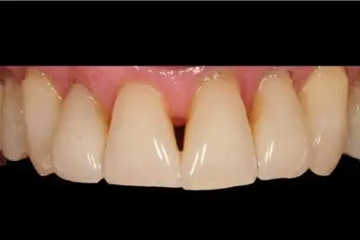 Smile Makeover before at Dentistry of Newport Beach in Newport Beach, CA