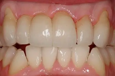 Dentistry of Newport Beach smile makeover after — Newport Beach, CA