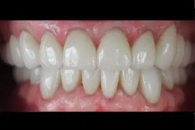 Smile Makeover after at Dentistry of Newport Beach in Newport Beach, CA
