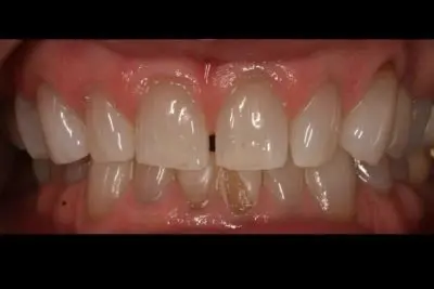 Smile Makeover before at Dentistry of Newport Beach in Newport Beach, CA