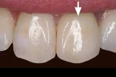 Dentistry of Newport Beach smile makeover after — Newport Beach, CA