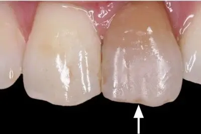 Smile Makeover before at Dentistry of Newport Beach in Newport Beach, CA