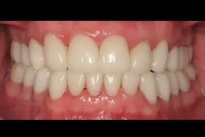 Dentistry of Newport Beach smile makeover after — Newport Beach, CA