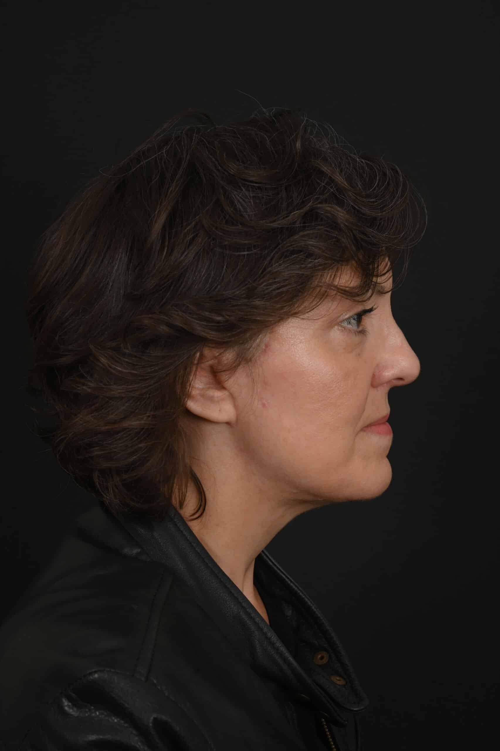 Siegel Facial Plastic Surgery facelift after — Houston, TX
