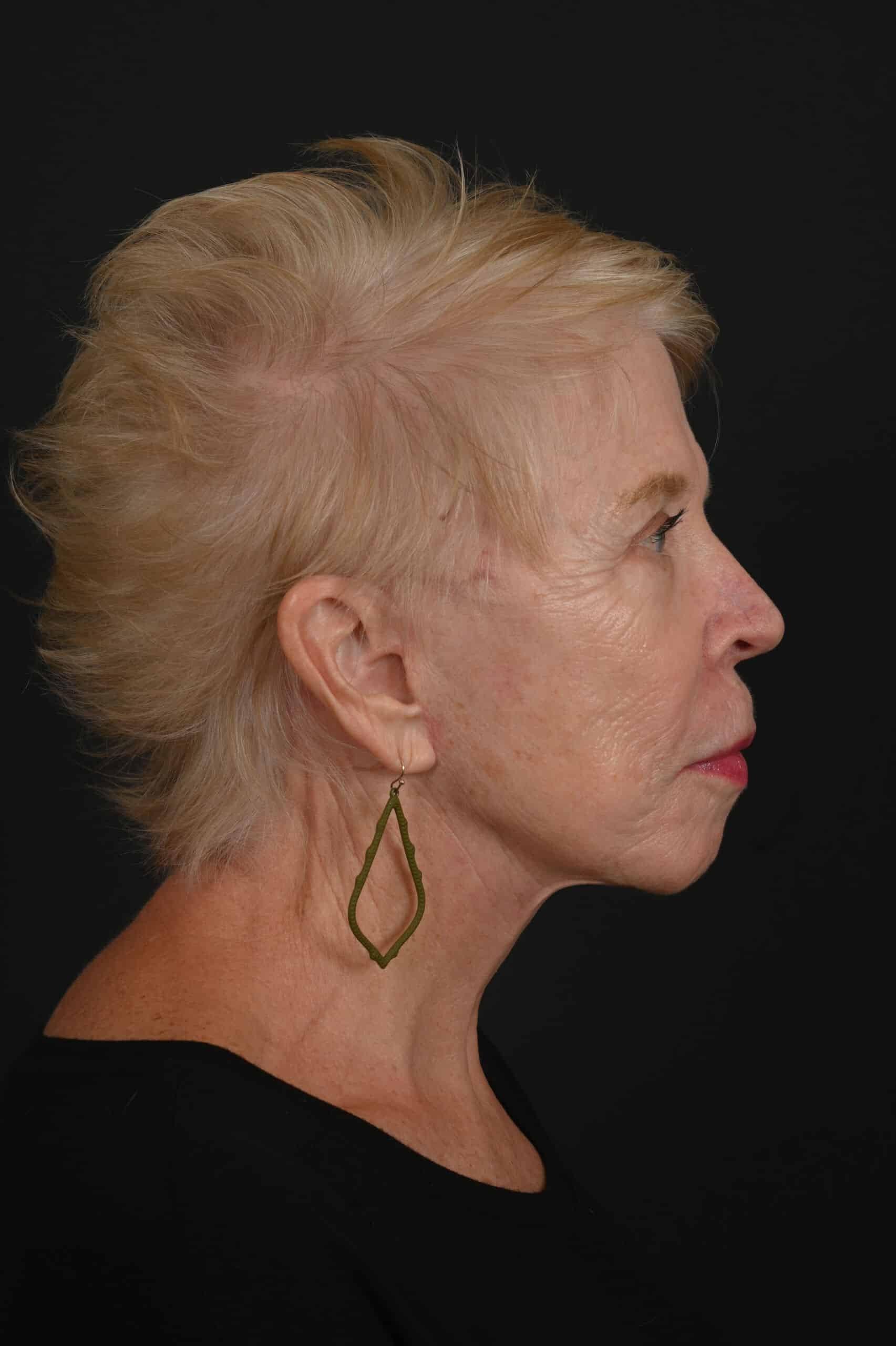 Siegel Facial Plastic Surgery facelift after — Houston, TX