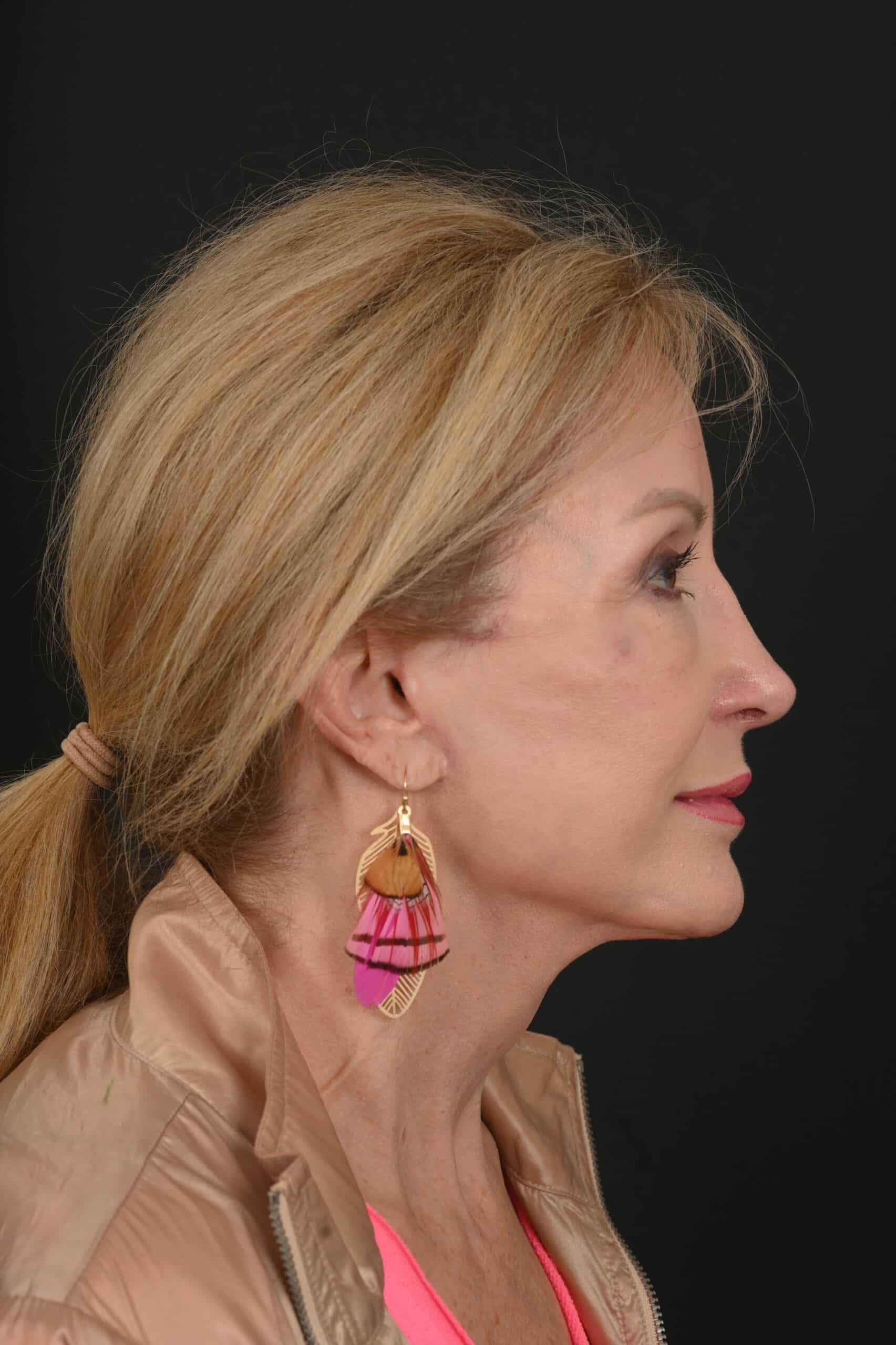 Siegel Facial Plastic Surgery facelift after — Houston, TX