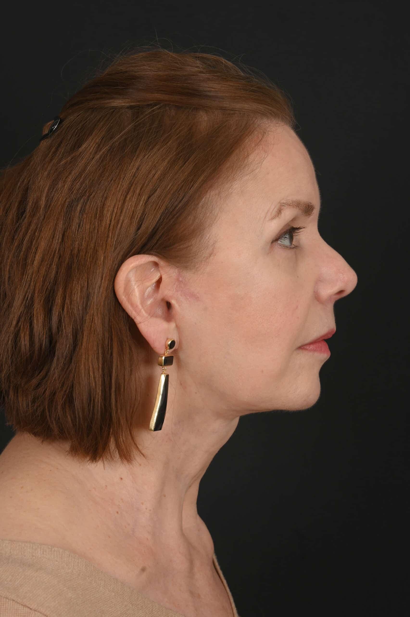 Siegel Facial Plastic Surgery facelift after — Houston, TX