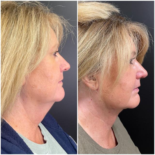 Neck Liposuction result at BodyPoint Medspa in Lehi, UT