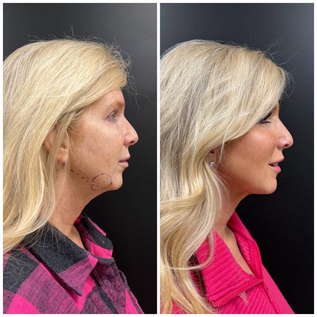 Neck Liposuction result at BodyPoint Medspa in Lehi, UT