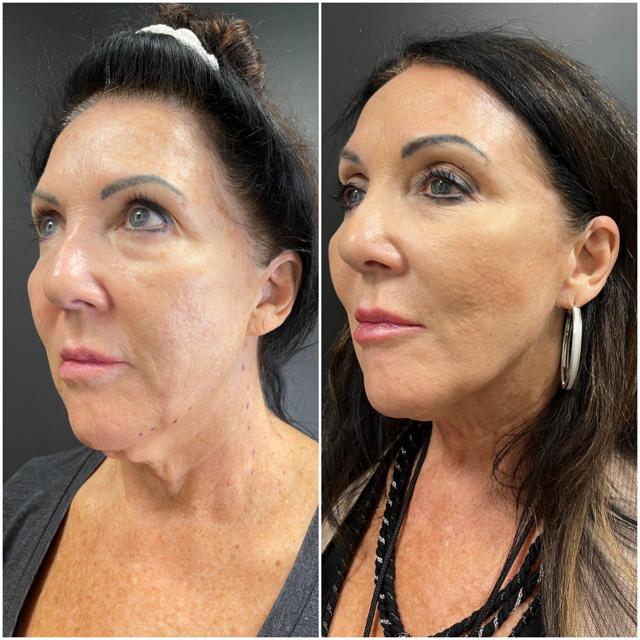 Neck Liposuction result at BodyPoint Medspa in Lehi, UT