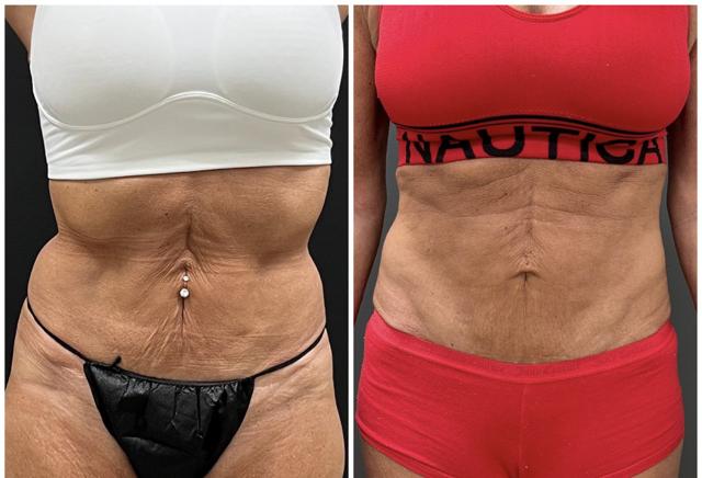 Liposuction result at BodyPoint Medspa in Lehi, UT