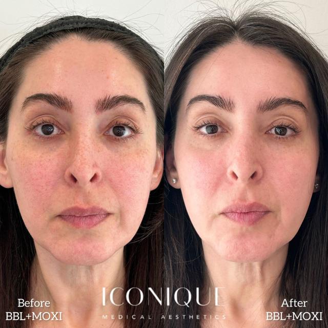 Laser Skin Resurfacing result at Iconique Medical Aesthetics in Costa Mesa, CA