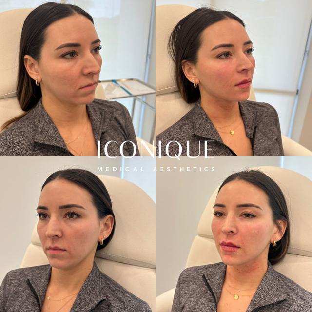 Lip Filler result at Iconique Medical Aesthetics in Costa Mesa, CA