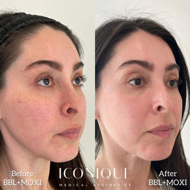 Laser Skin Resurfacing result at Iconique Medical Aesthetics in Costa Mesa, CA