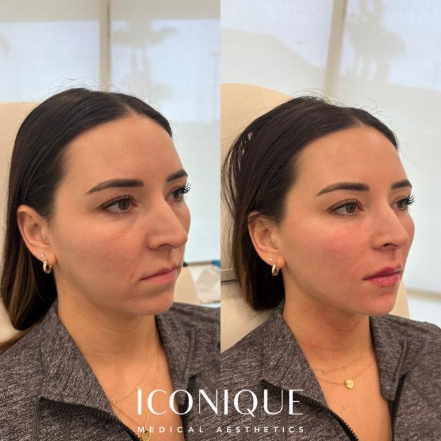 Lip Filler result at Iconique Medical Aesthetics in Costa Mesa, CA