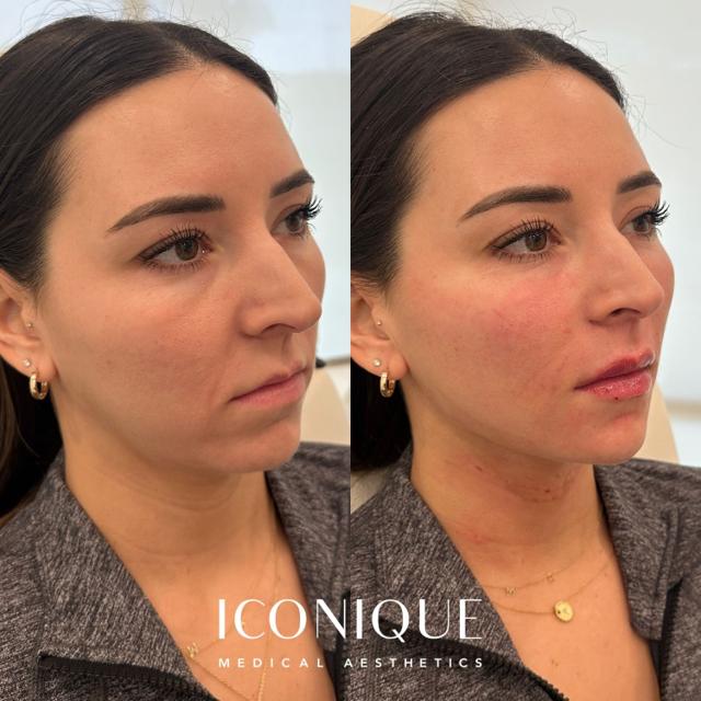Lip Filler result at Iconique Medical Aesthetics in Costa Mesa, CA