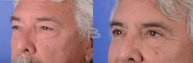 Blepharoplasty result at Bolitho MD in San Diego, CA