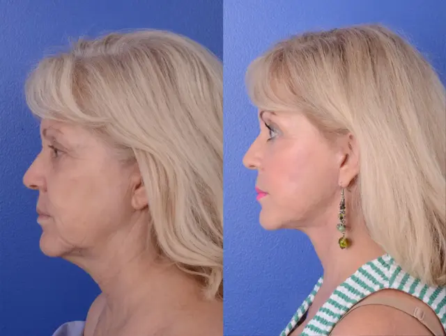 Facelift result at Bolitho MD in San Diego, CA