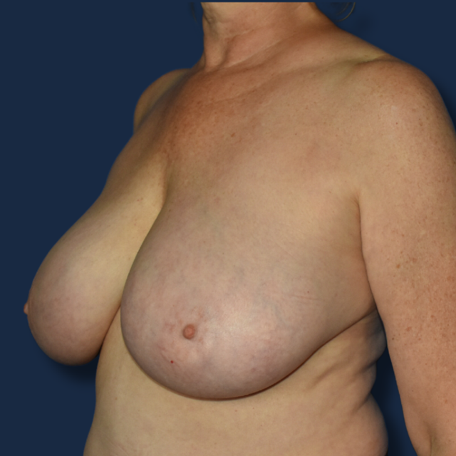 Breast Reduction before at The Surgeonista - Gina Maccarone MD, FACS in Cincinnati, OH