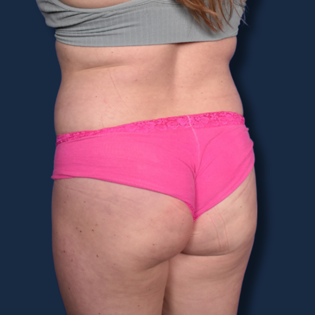 Liposuction before at The Surgeonista - Gina Maccarone MD, FACS in Cincinnati, OH