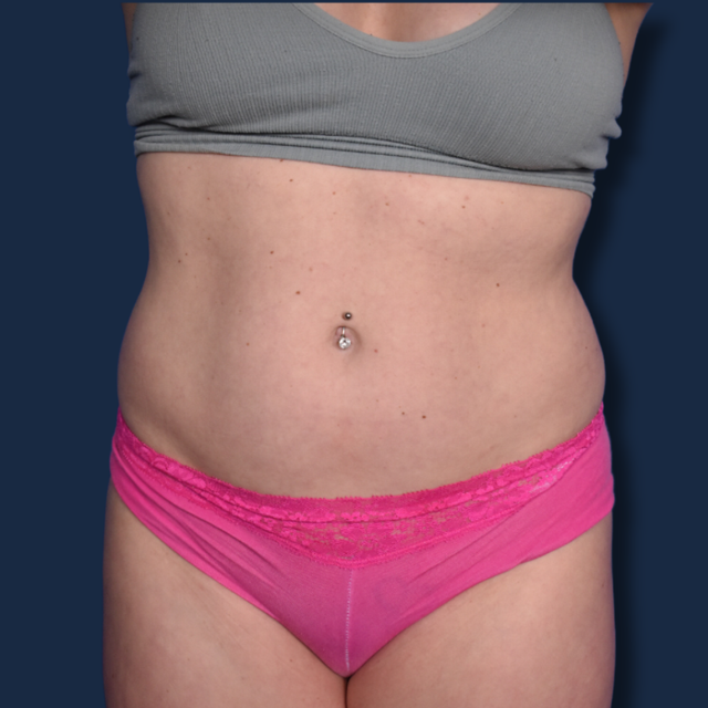 Liposuction before at The Surgeonista - Gina Maccarone MD, FACS in Cincinnati, OH