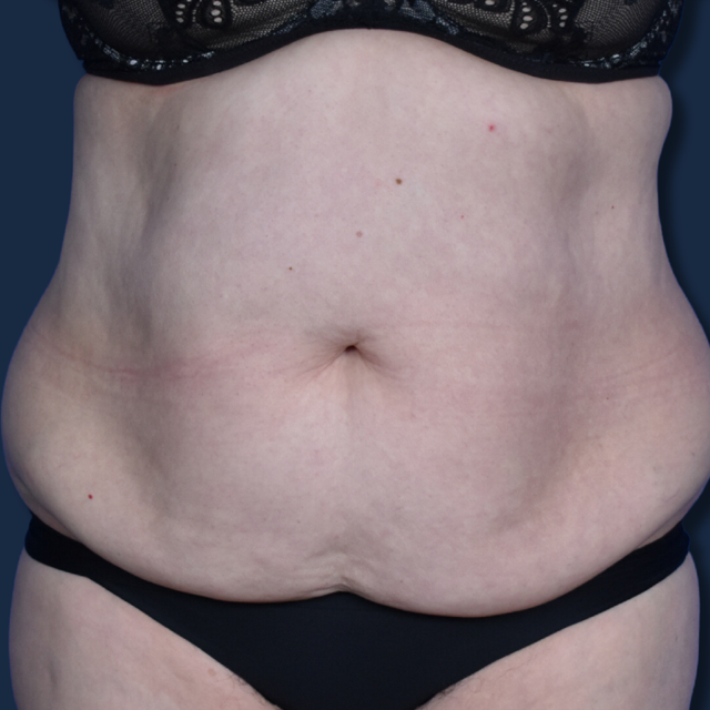 Mini Tummy Tuck before at The Surgeonista - Gina Maccarone MD, FACS in Cincinnati, OH