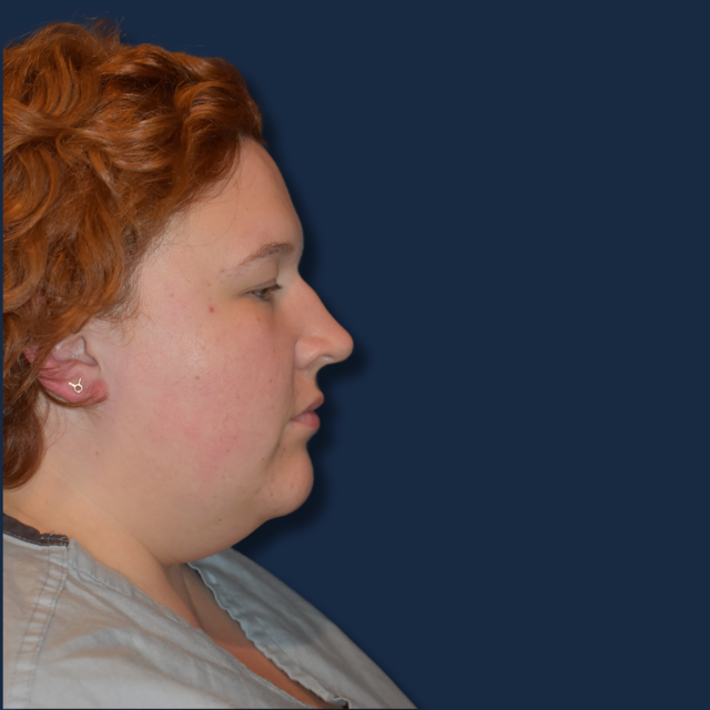 Neck Liposuction before at The Surgeonista - Gina Maccarone MD, FACS in Cincinnati, OH