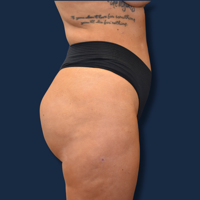 Brazilian Butt Lift after at The Surgeonista - Gina Maccarone MD, FACS in Cincinnati, OH