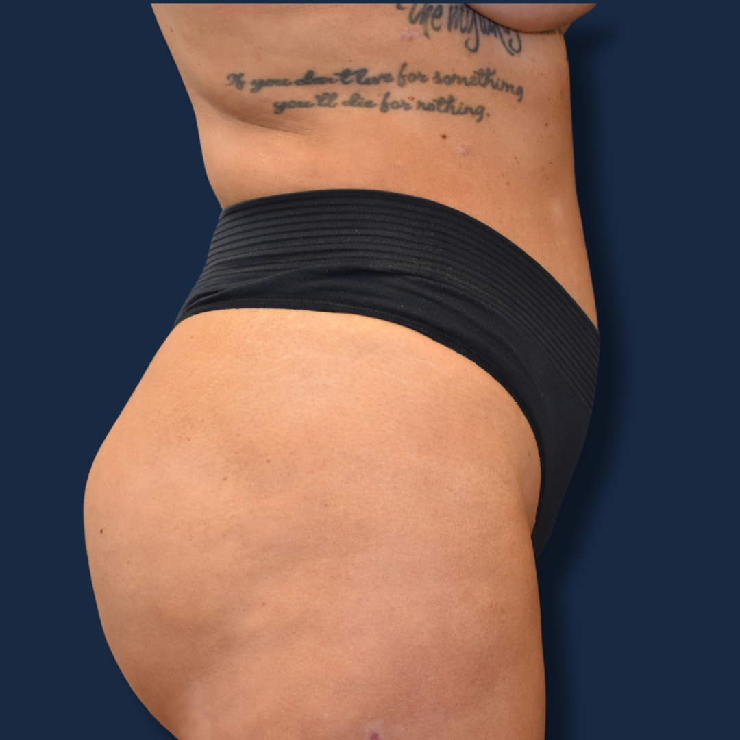 The Surgeonista - Gina Maccarone MD, FACS bbl after — Cincinnati, OH
