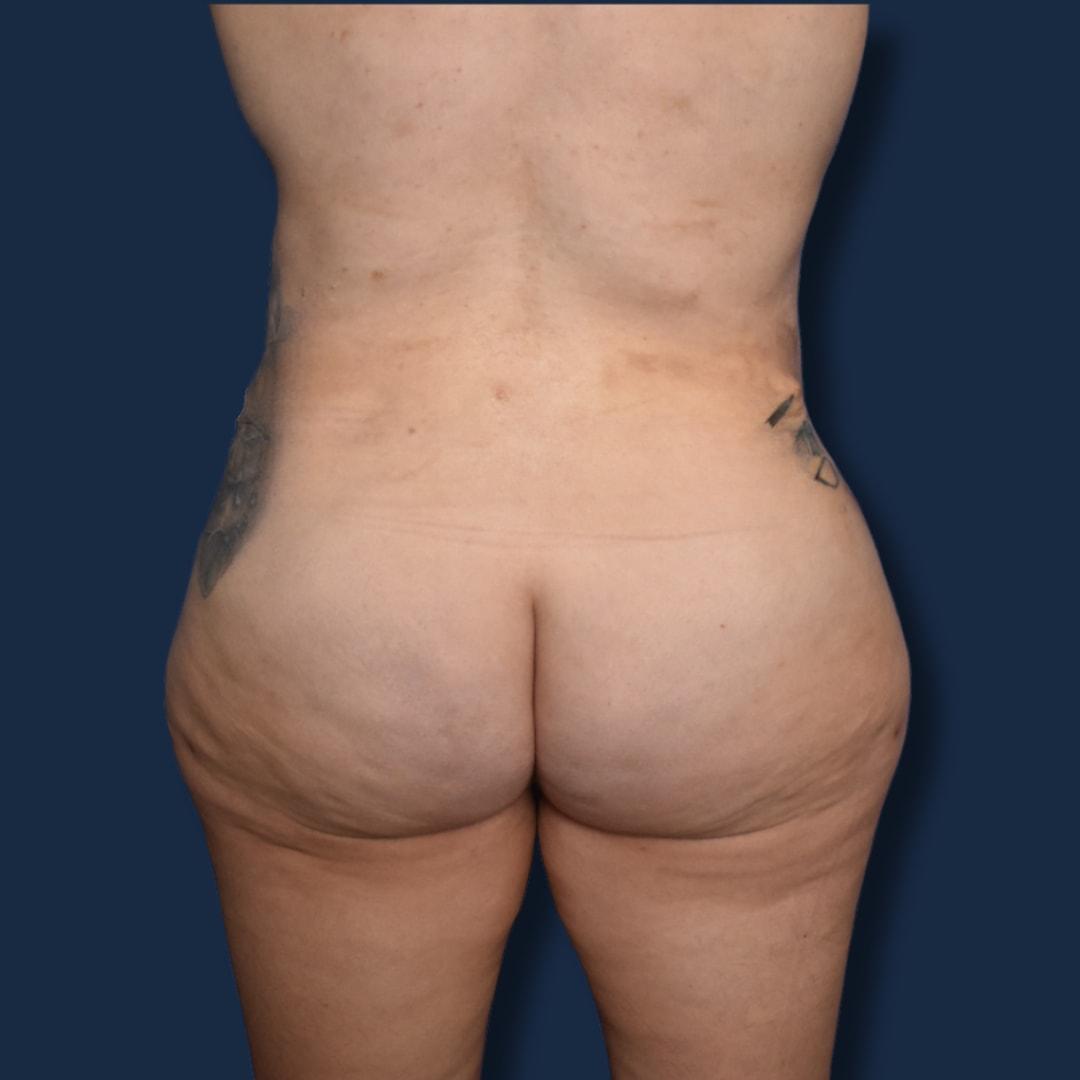 The Surgeonista - Gina Maccarone MD, FACS bbl after — Cincinnati, OH
