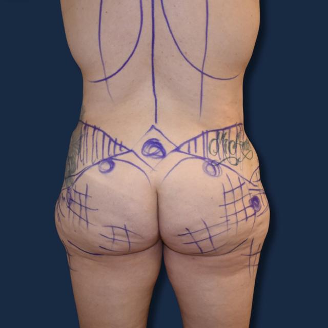 Brazilian Butt Lift before at The Surgeonista - Gina Maccarone MD, FACS in Cincinnati, OH