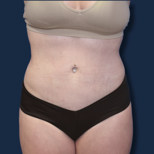 Liposuction after at The Surgeonista - Gina Maccarone MD, FACS in Cincinnati, OH