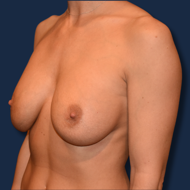 Breast Augmentation before at The Surgeonista - Gina Maccarone MD, FACS in Cincinnati, OH