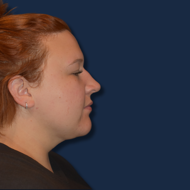 Neck Liposuction after at The Surgeonista - Gina Maccarone MD, FACS in Cincinnati, OH