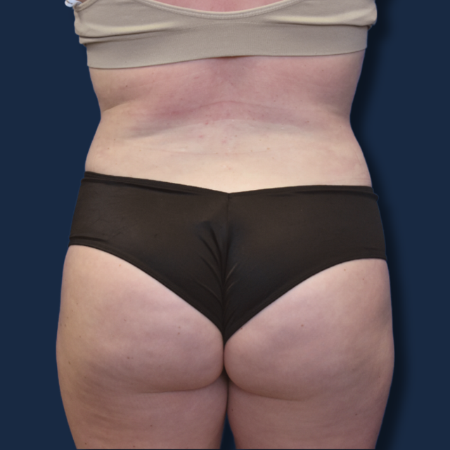 Liposuction after at The Surgeonista - Gina Maccarone MD, FACS in Cincinnati, OH