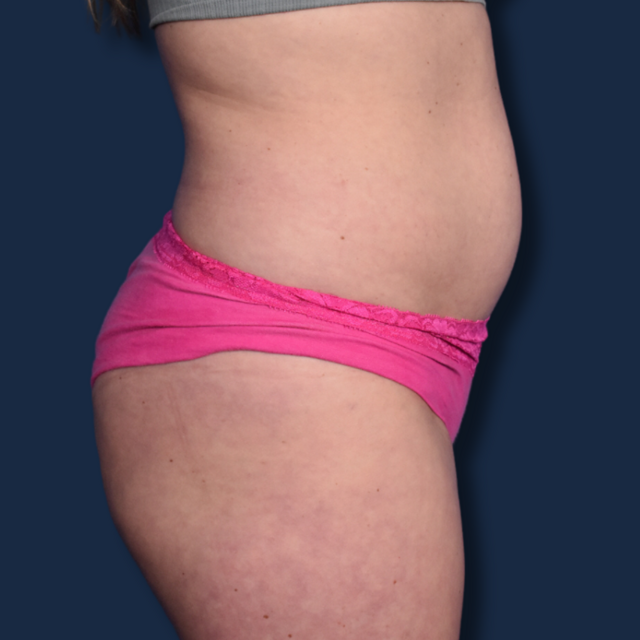 Liposuction before at The Surgeonista - Gina Maccarone MD, FACS in Cincinnati, OH