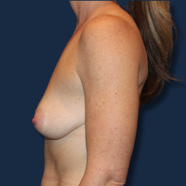 Breast Augmentation before at The Surgeonista - Gina Maccarone MD, FACS in Cincinnati, OH