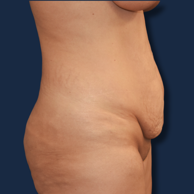 Mini Tummy Tuck before at The Surgeonista - Gina Maccarone MD, FACS in Cincinnati, OH