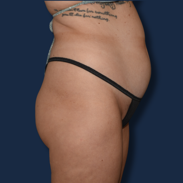 Brazilian Butt Lift before at The Surgeonista - Gina Maccarone MD, FACS in Cincinnati, OH