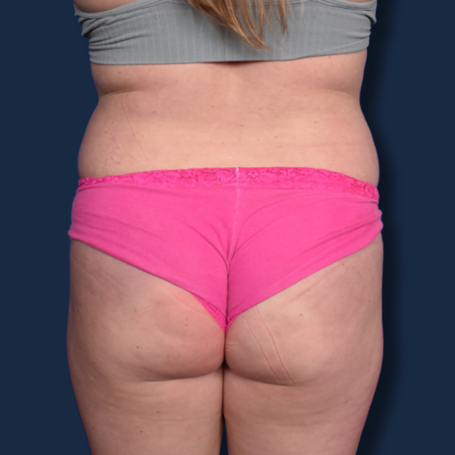Liposuction before at The Surgeonista - Gina Maccarone MD, FACS in Cincinnati, OH
