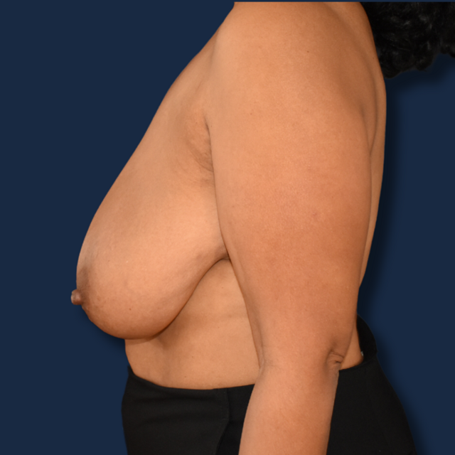 Breast Reduction before at The Surgeonista - Gina Maccarone MD, FACS in Cincinnati, OH