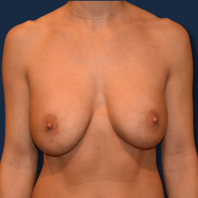 Breast Lift before at The Surgeonista - Gina Maccarone MD, FACS in Cincinnati, OH