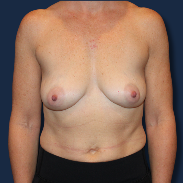 Breast Augmentation before at The Surgeonista - Gina Maccarone MD, FACS in Cincinnati, OH