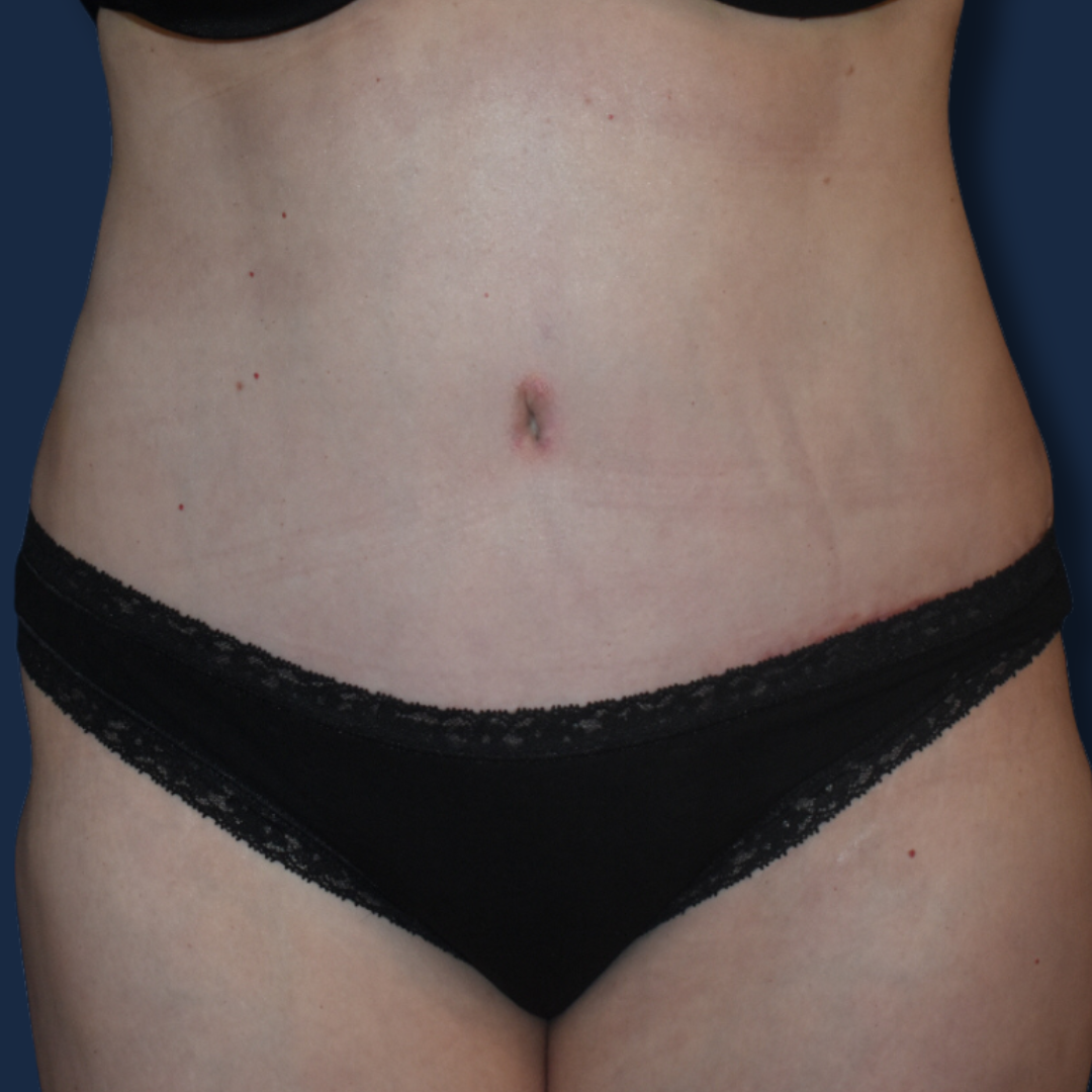 The Surgeonista - Gina Maccarone MD, FACS tummy tuck after — Cincinnati, OH