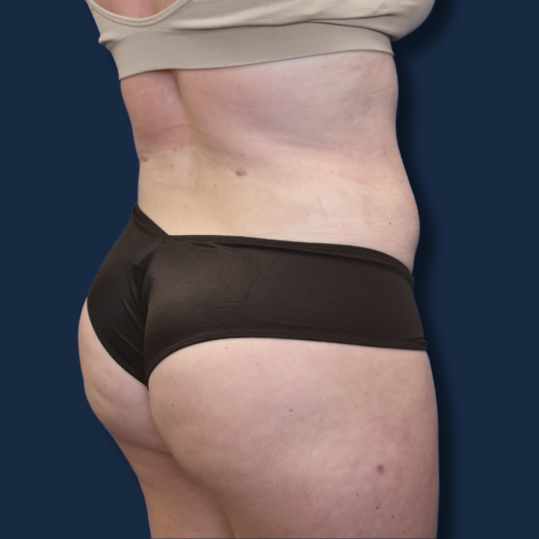 The Surgeonista - Gina Maccarone MD, FACS bbl after — Cincinnati, OH