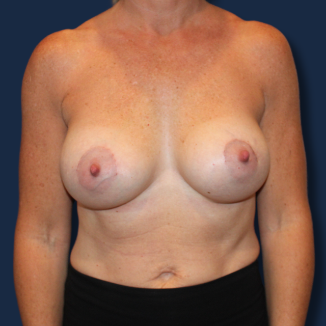Breast Augmentation after at The Surgeonista - Gina Maccarone MD, FACS in Cincinnati, OH