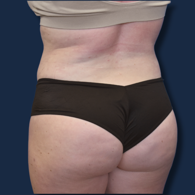 Liposuction after at The Surgeonista - Gina Maccarone MD, FACS in Cincinnati, OH